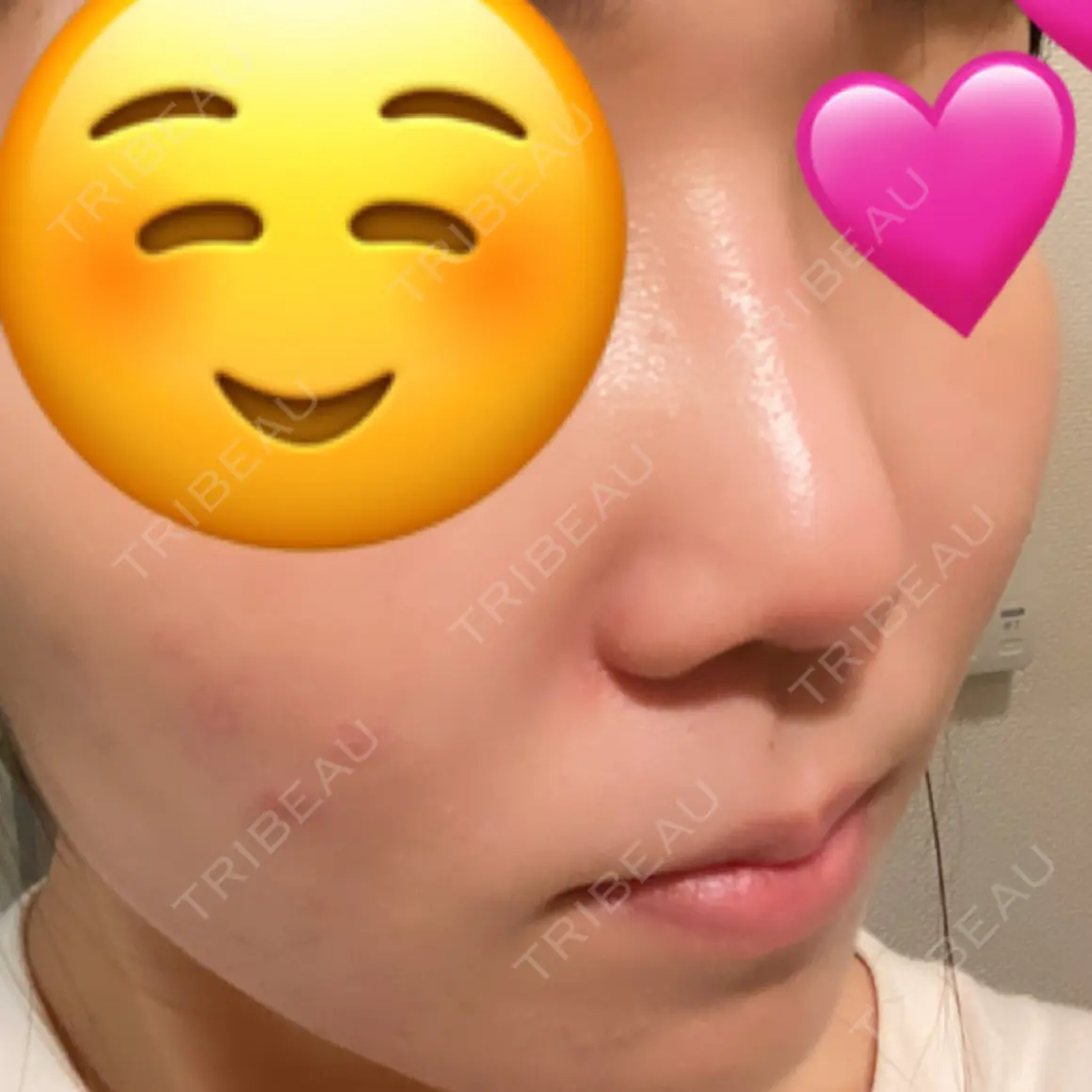 隆鼻術 / 鼻尖形成（切開） / 小鼻縮小（切開） / 脂肪吸引（顔） / 軟骨移植 MIL CLINIC OSAKA AFTER