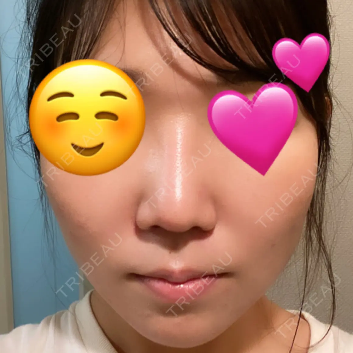 隆鼻術 / 鼻尖形成（切開） / 小鼻縮小（切開） / 脂肪吸引（顔） / 軟骨移植 MIL CLINIC OSAKA AFTER