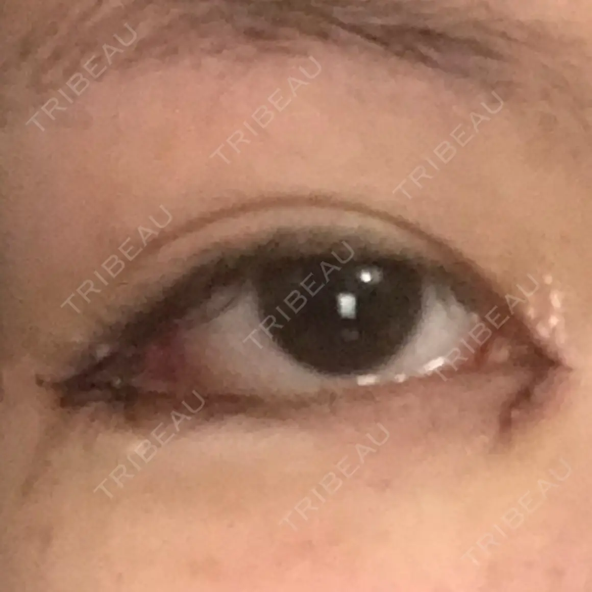 目頭切開 / 目尻切開 / 目尻靭帯移動 FROM B整形外科 (旧バウム整形外科) DAY 0