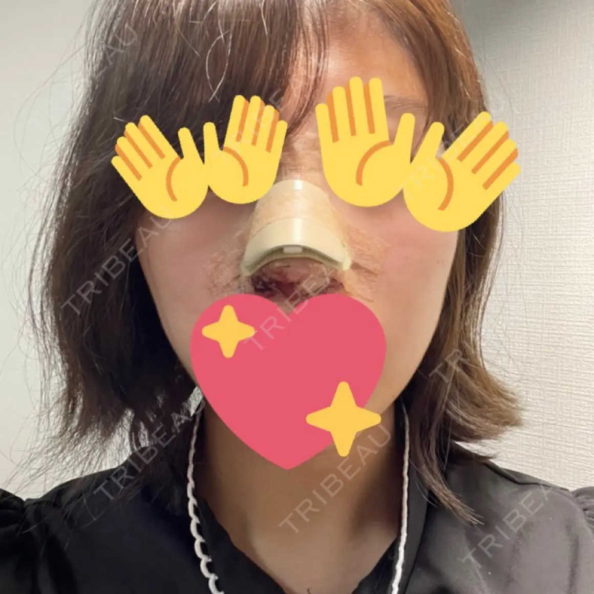 隆鼻術 / 鼻尖形成（切開） / 小鼻縮小（切開） / 軟骨移植 グローバルビューティークリニック 大阪院 DAY 0