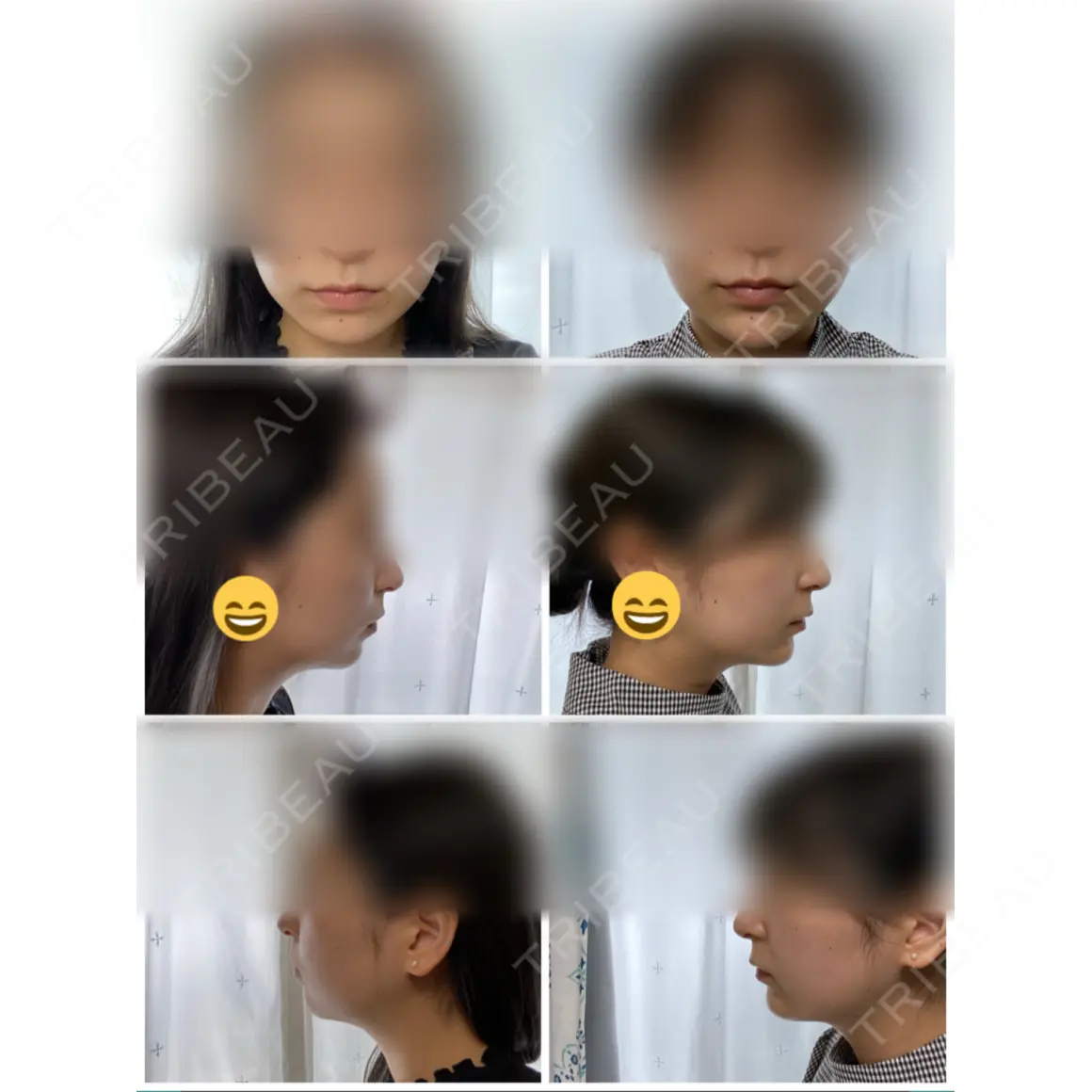 ヒアルロン酸注入（あご） / 脂肪溶解注射（顔） id美容クリニック 銀座院 AFTER