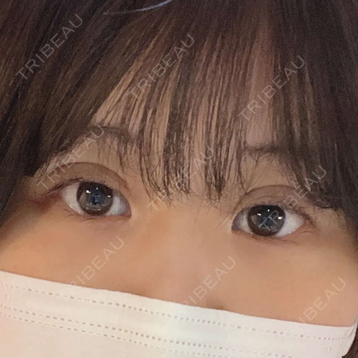 二重埋没 TCB東京中央美容外科 上野院 DAY 0