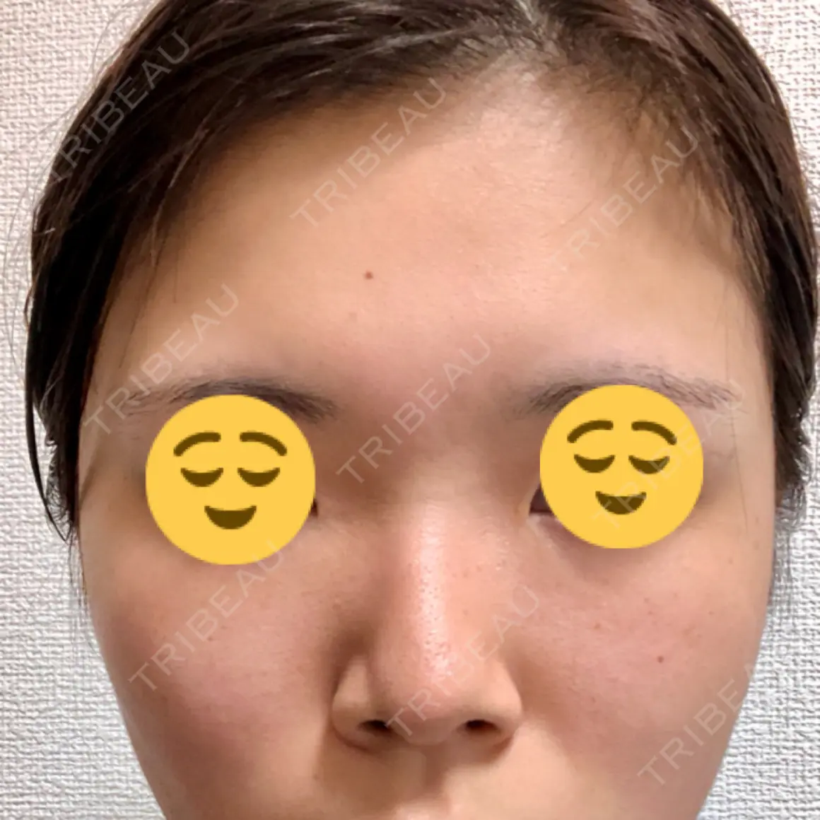 軟骨移植 フェアクリニック川口 AFTER