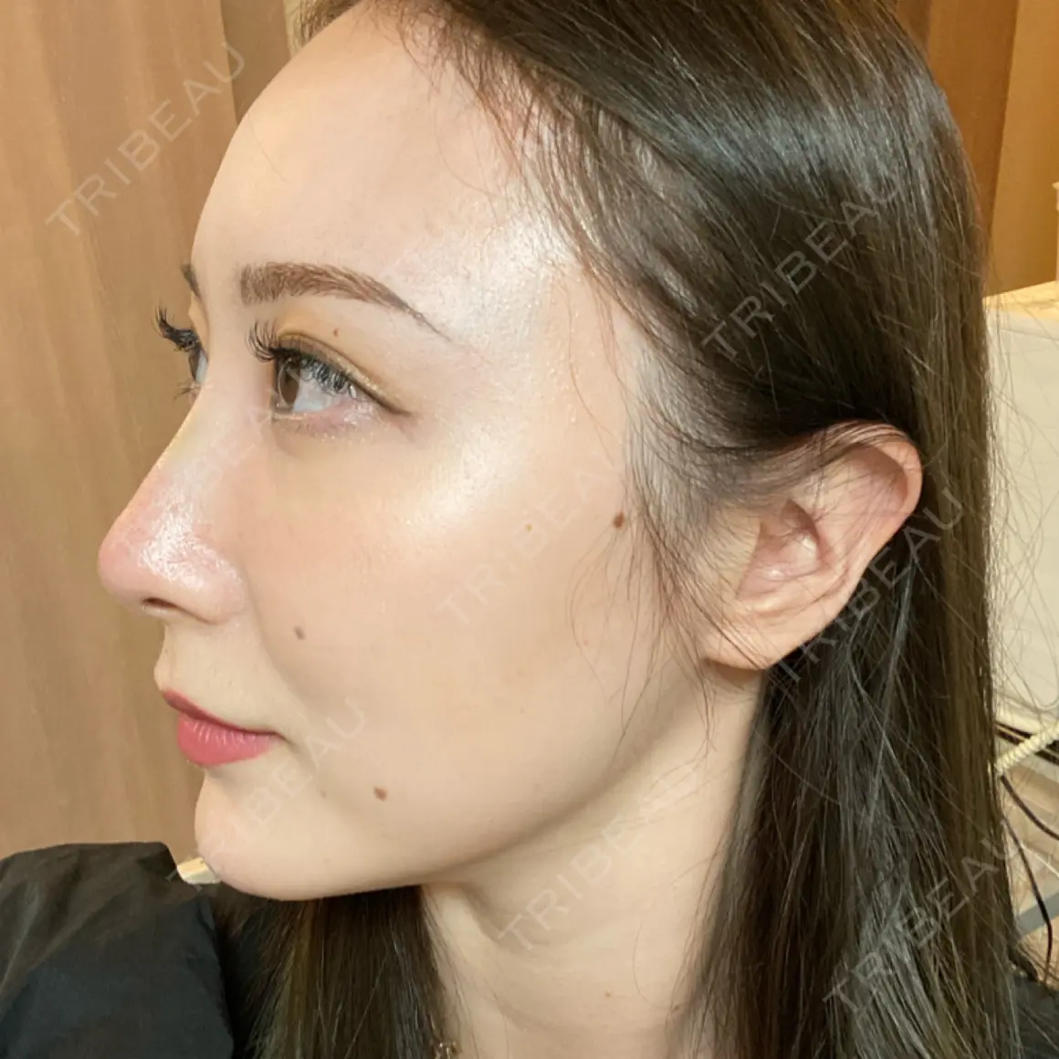 ヒアルロン酸注入（鼻） BIANCA銀座 DAY 0