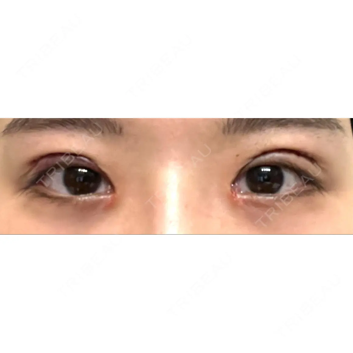 二重切開 / 目元修正 JUN CLINIC DAY 0