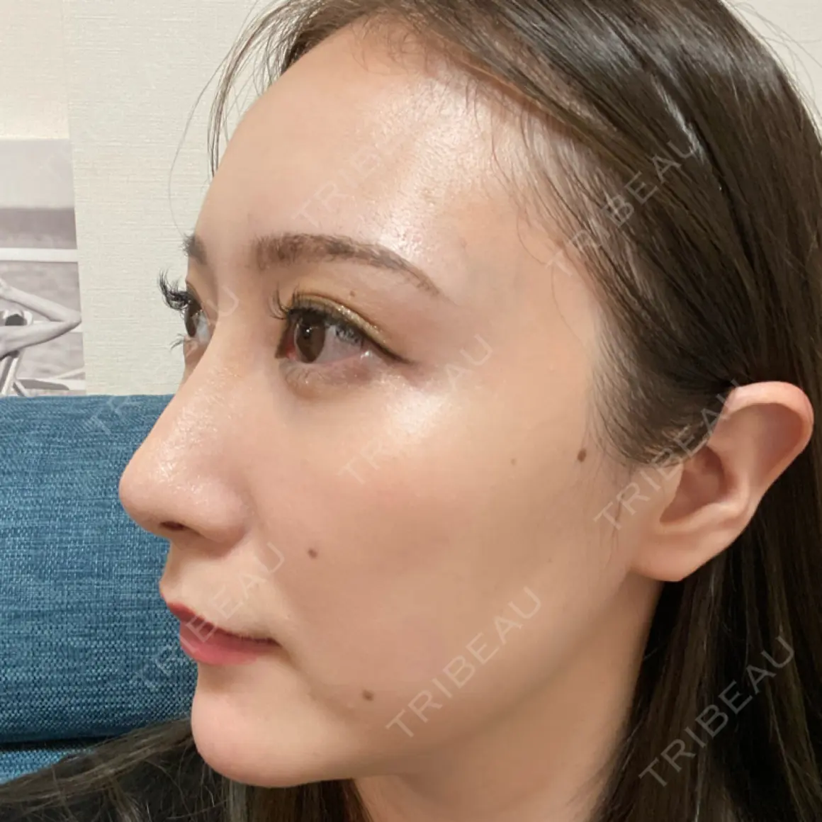 ヒアルロン酸注入（鼻） BIANCA銀座 AFTER