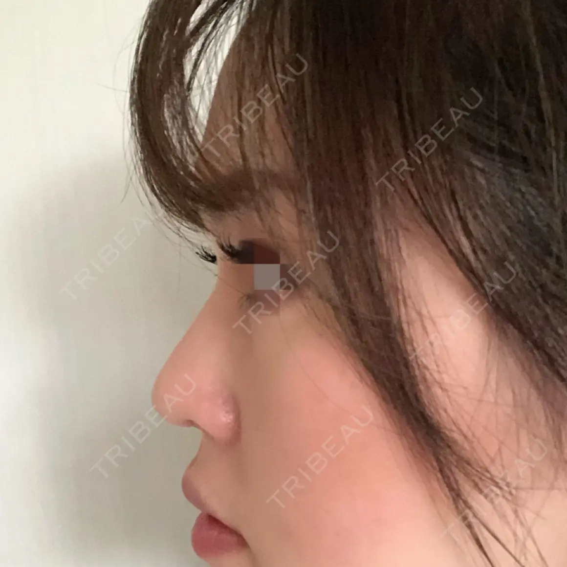 鼻尖形成（切開） / 鼻中隔延長（切開） / 小鼻縮小（切開） / 軟骨移植 / 鼻翼基部形成（貴族手術） AiZ CLINIC AFTER