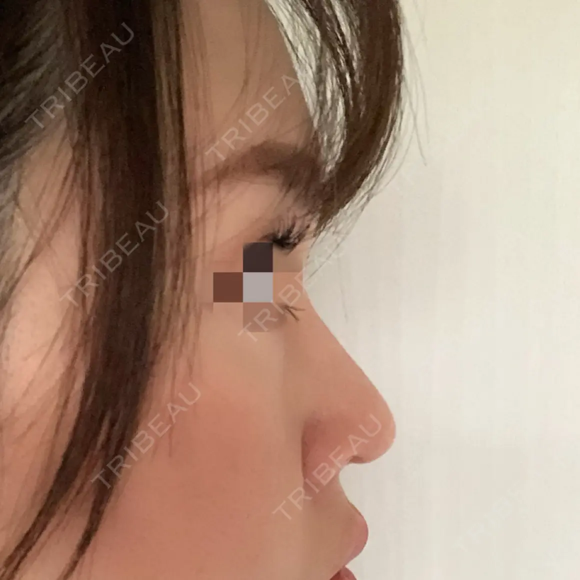 鼻尖形成（切開） / 鼻中隔延長（切開） / 小鼻縮小（切開） / 軟骨移植 / 鼻翼基部形成（貴族手術） AiZ CLINIC AFTER
