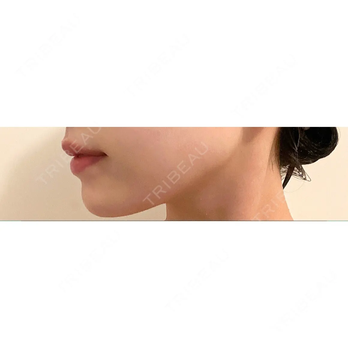ヒアルロン酸注入（あご） id美容クリニック 銀座院 AFTER