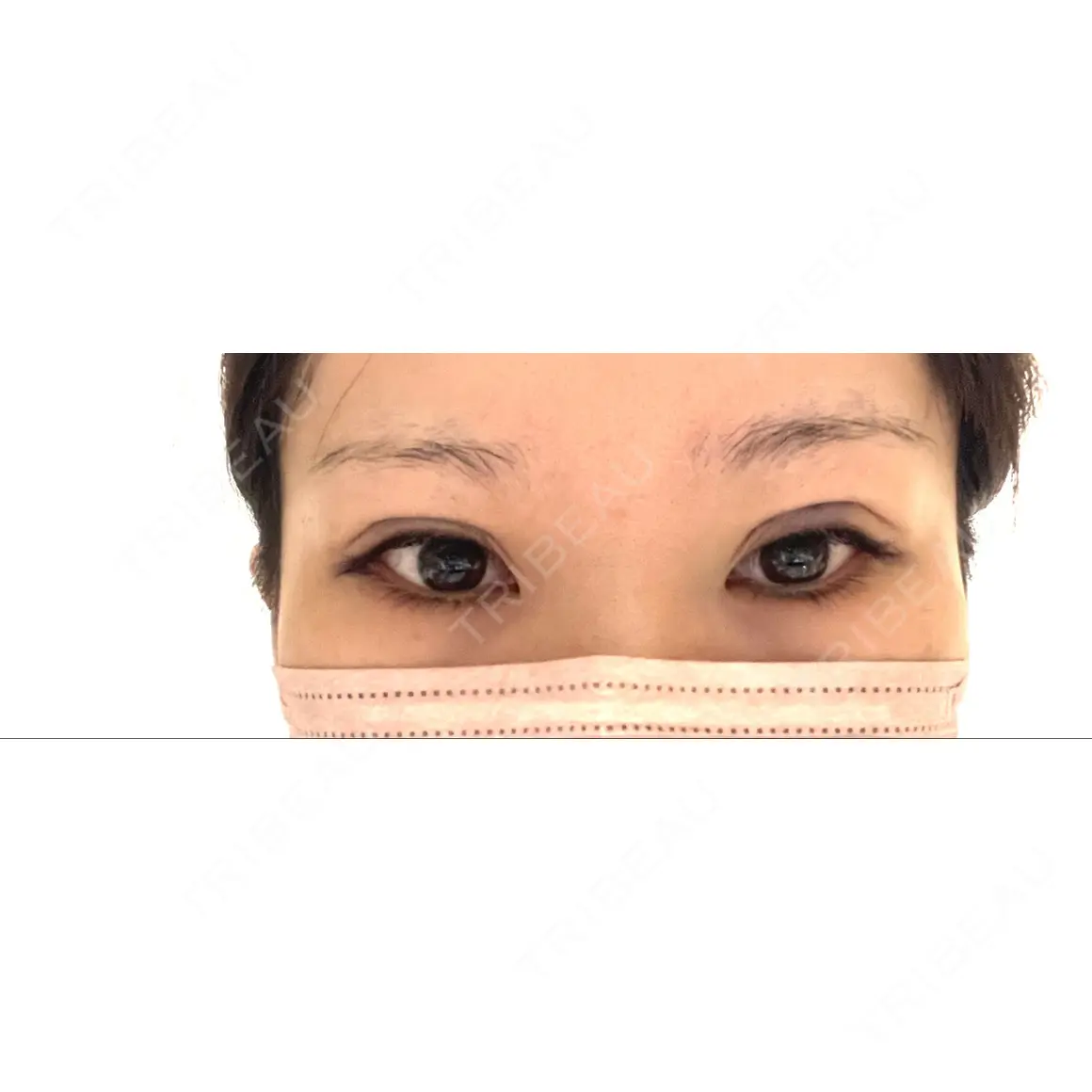二重切開 / 眼瞼下垂（切開） / 目尻切開 サラ美容外科 DAY 0