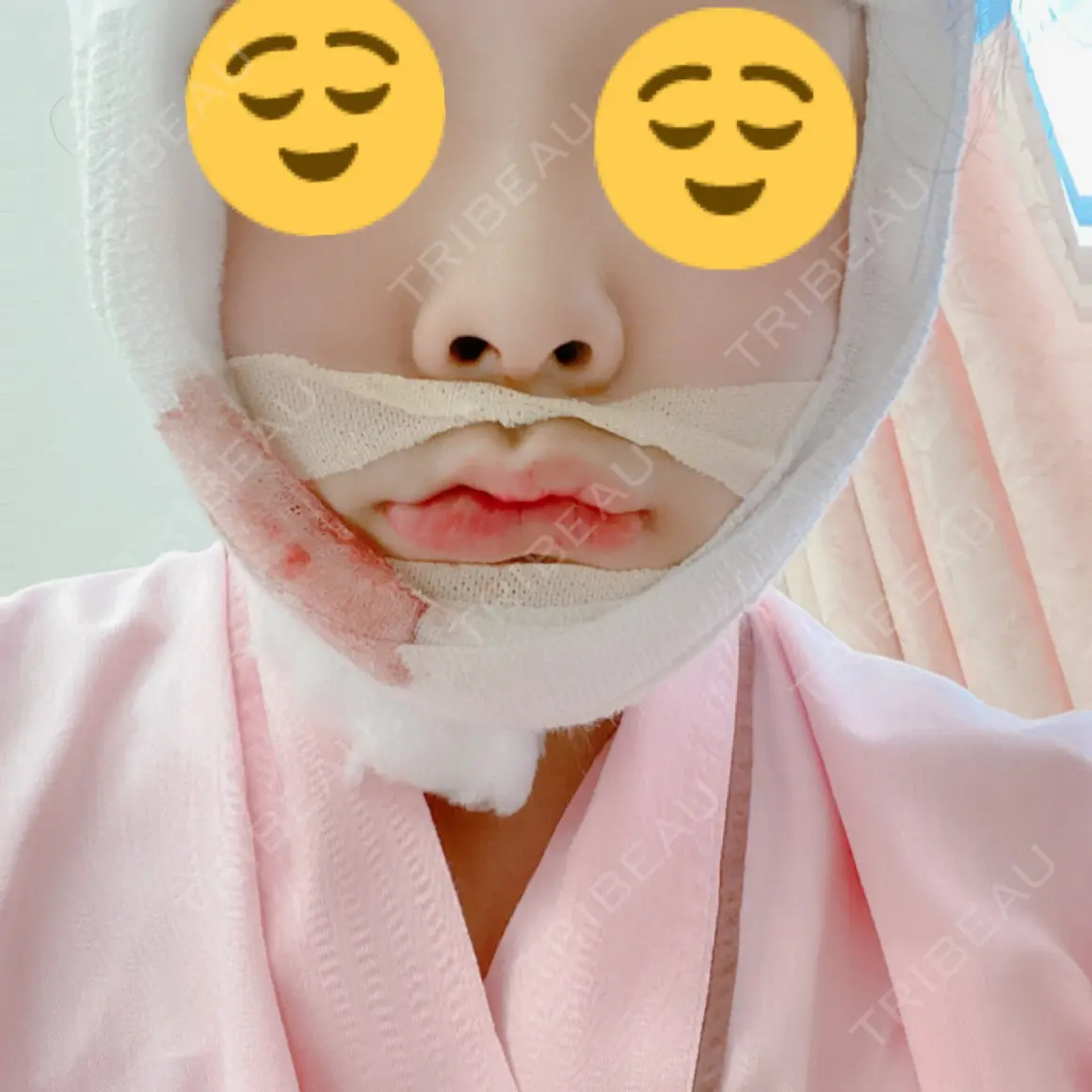 セットバック 大塚美容形成外科・歯科 大塚本院 DAY 1