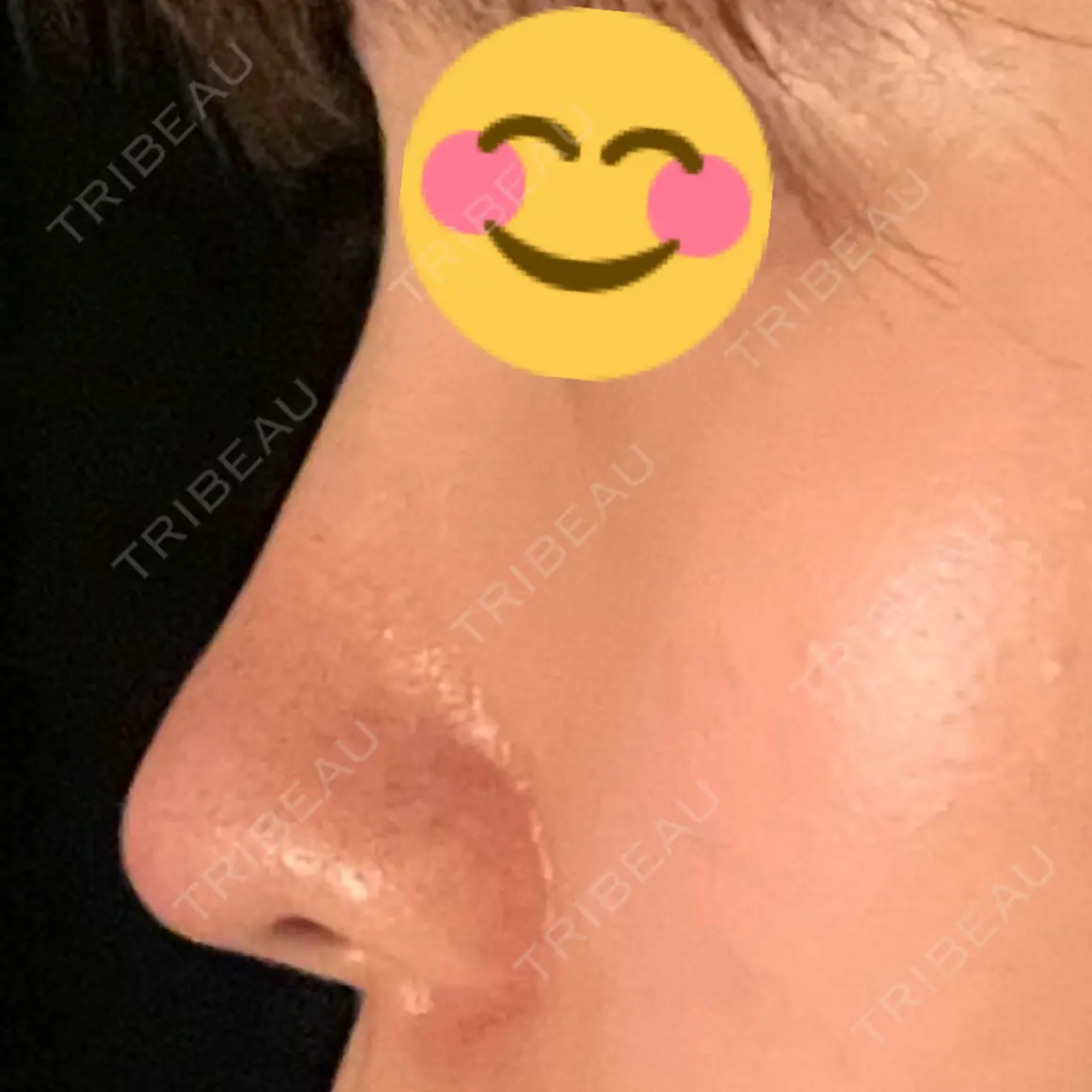 軟骨移植 フェアクリニック川口 AFTER