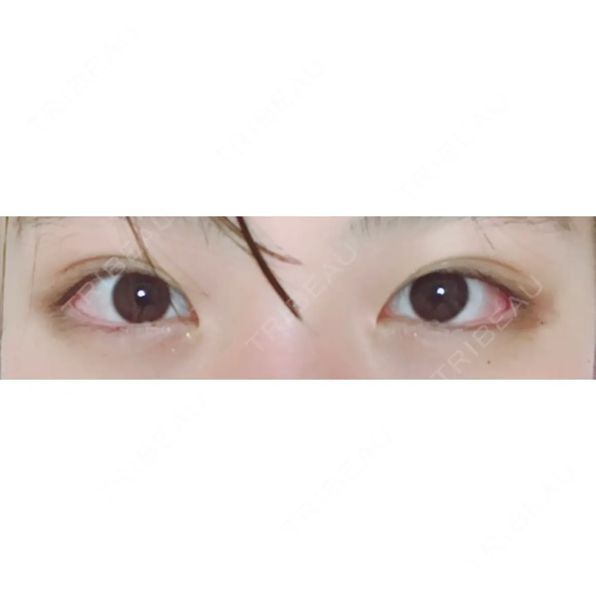 二重切開 / 目頭切開 高須クリニック 名古屋院 AFTER