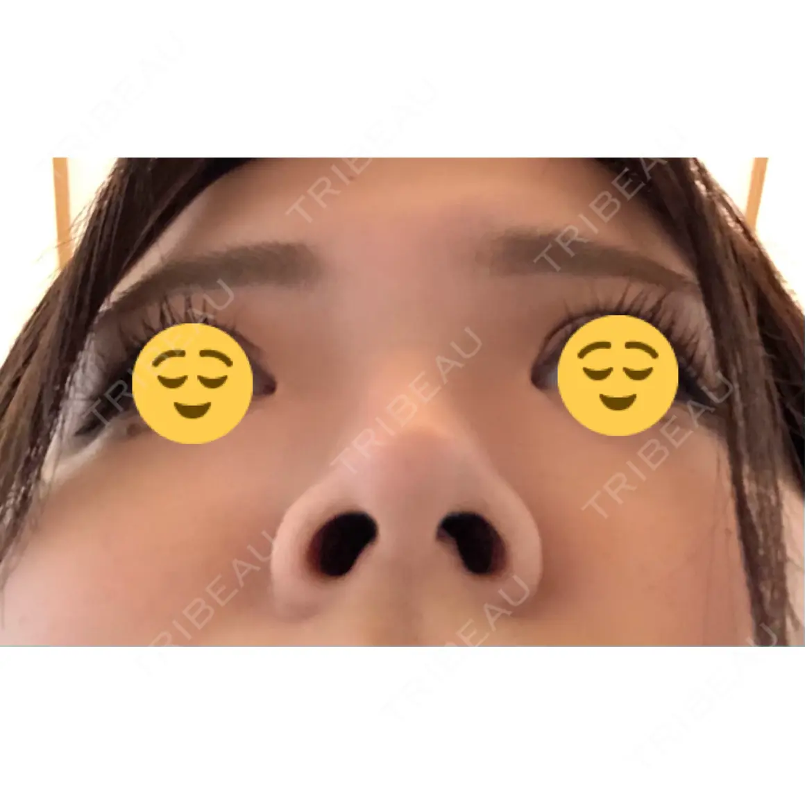 軟骨移植 フェアクリニック川口 AFTER