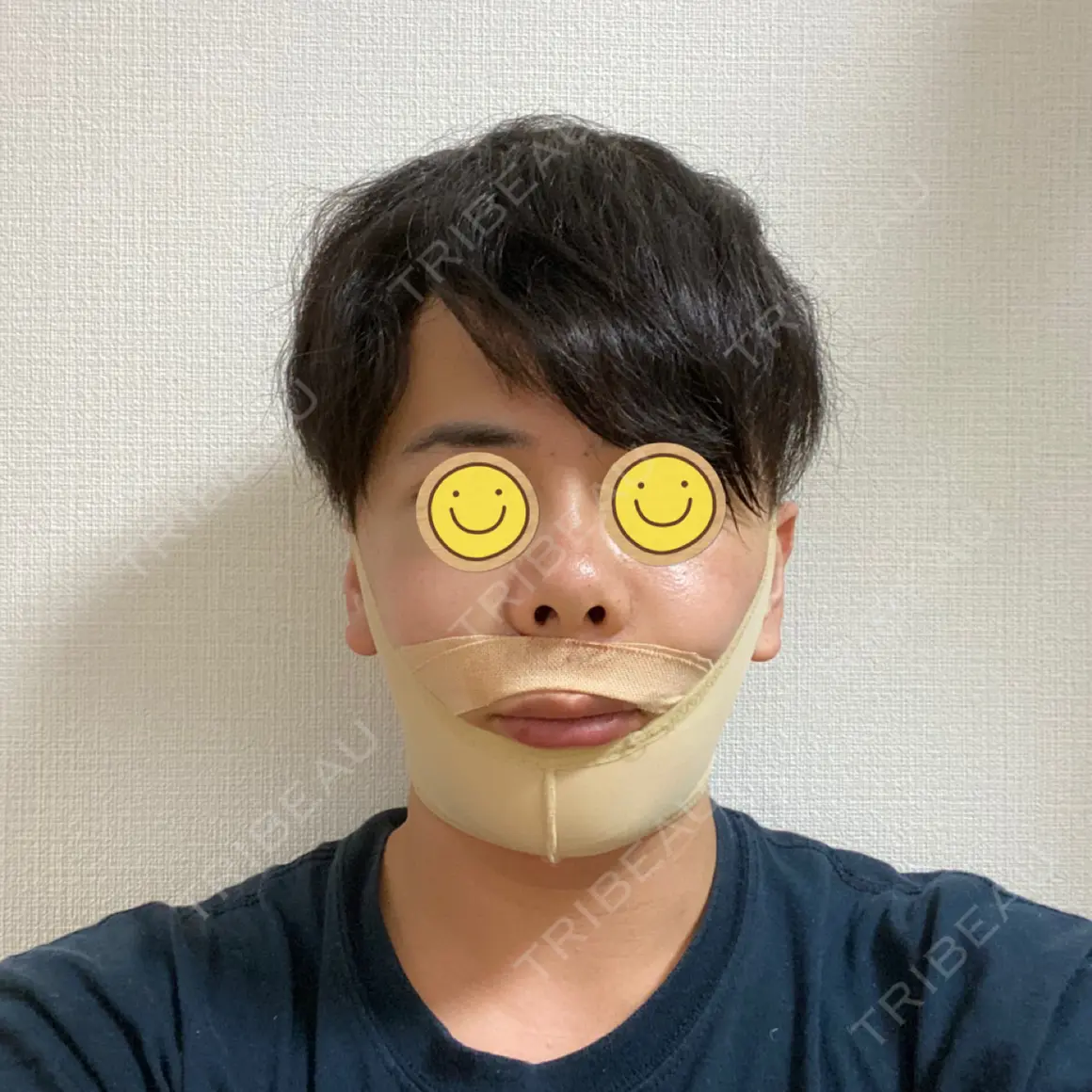 骨切り（あご） / セットバック アーククリニック DAY 1