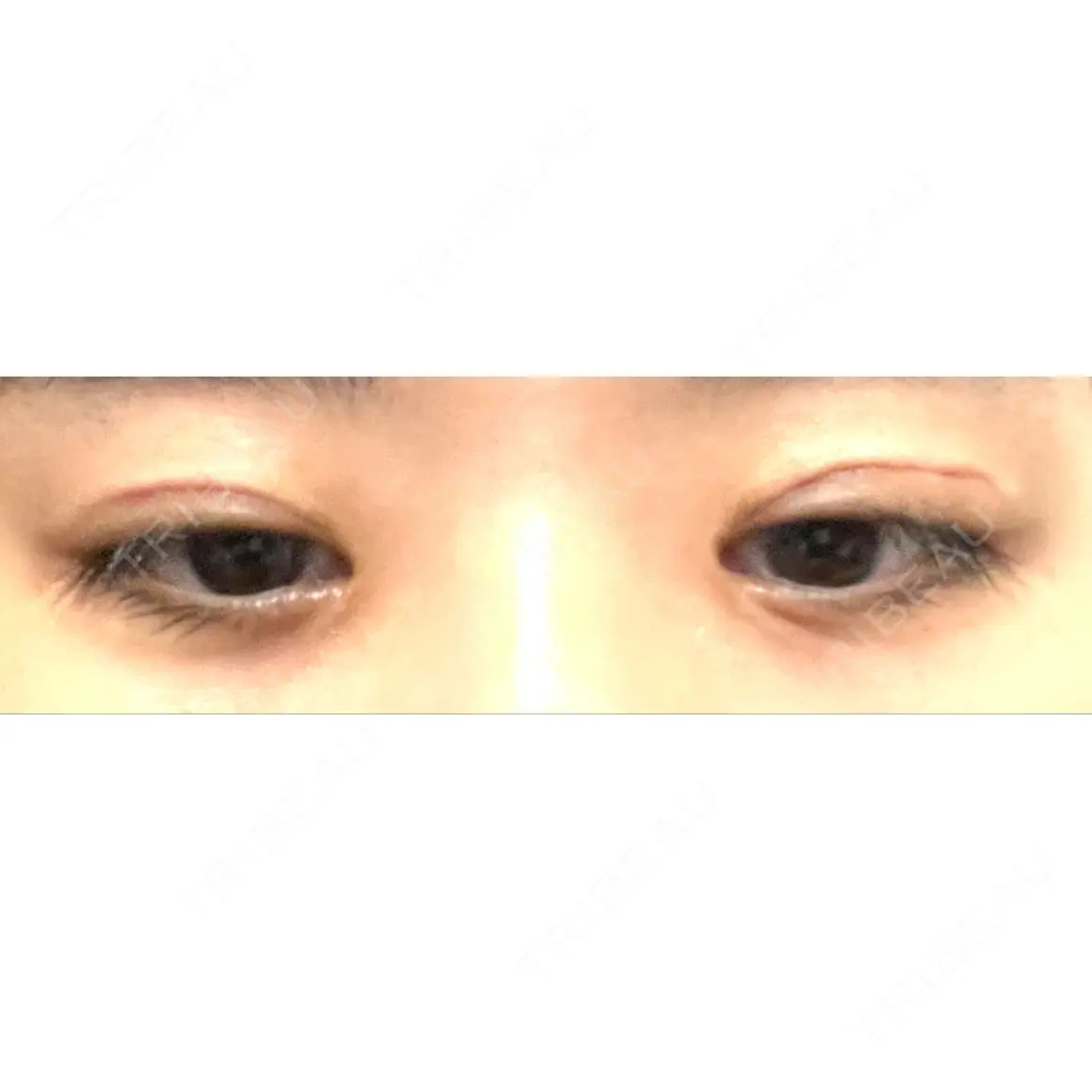 二重切開 / 目元修正 JUN CLINIC AFTER