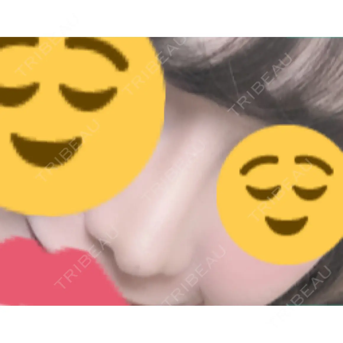 隆鼻術 / 鼻尖形成（切開） / 小鼻縮小（切開） / 骨切幅寄せ オペラ整形外科 AFTER