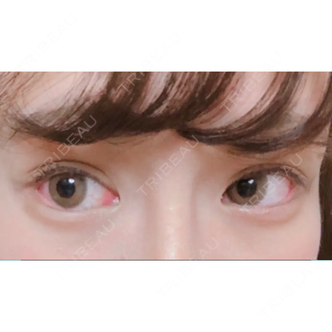 目尻切開 / タレ目形成・グラマラスライン（切開） オペラ整形外科 AFTER