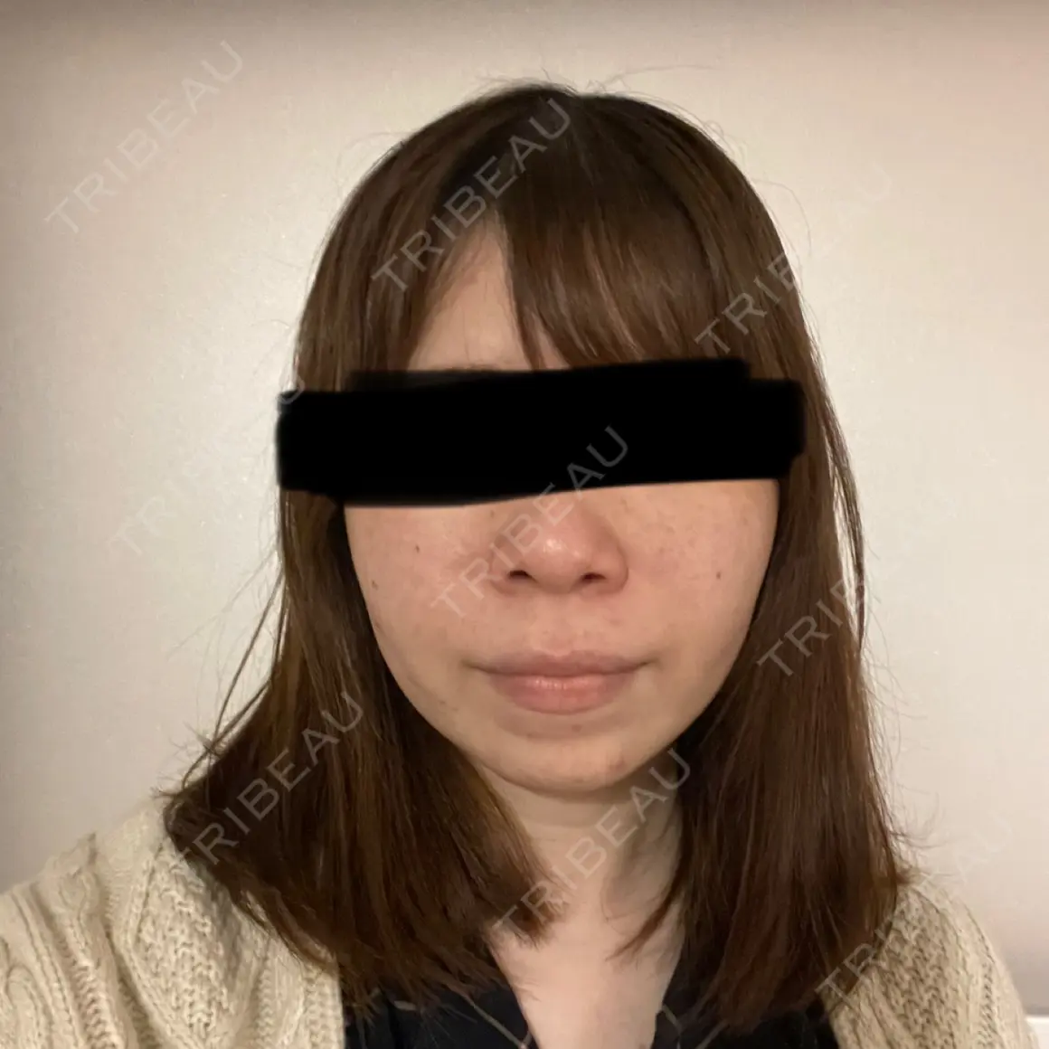 メーラーファット除去 藤・ナチュレ美容クリニック 恵比寿院 AFTER