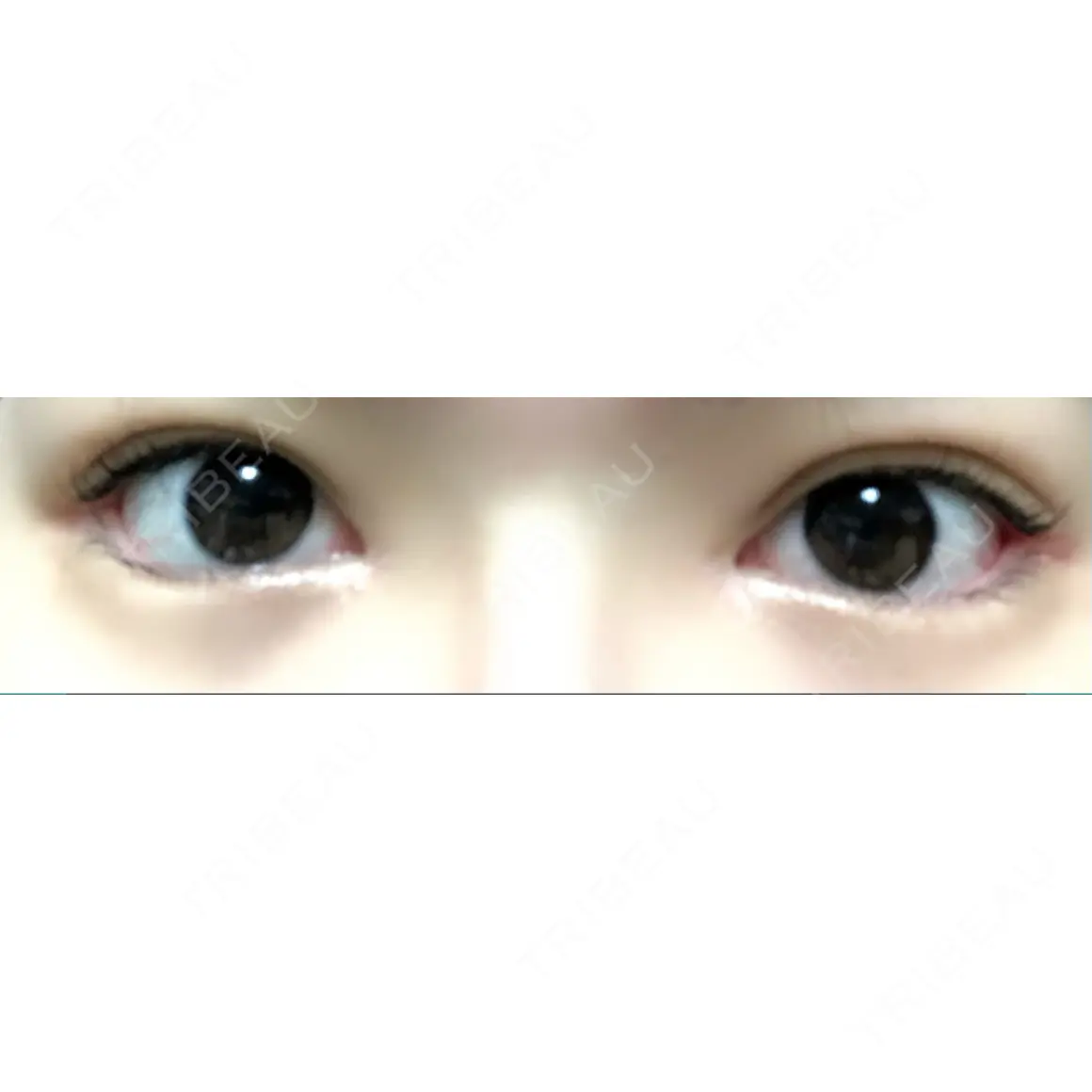 目頭切開 / 眼瞼下垂（切開） / 目尻切開 / 上まぶたの脂肪取り / タレ目形成・グラマラスライン（切開） BIANCA銀座 AFTER