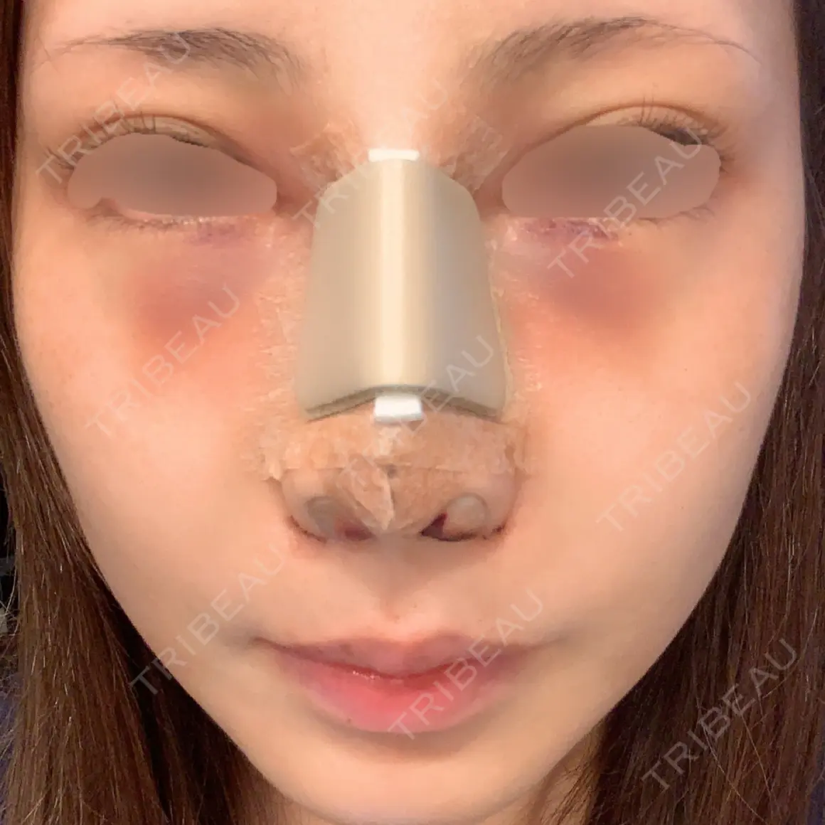 小鼻縮小（切開） / 骨切幅寄せ VENUS BEAUTY CLINIC　銀座院 DAY 1