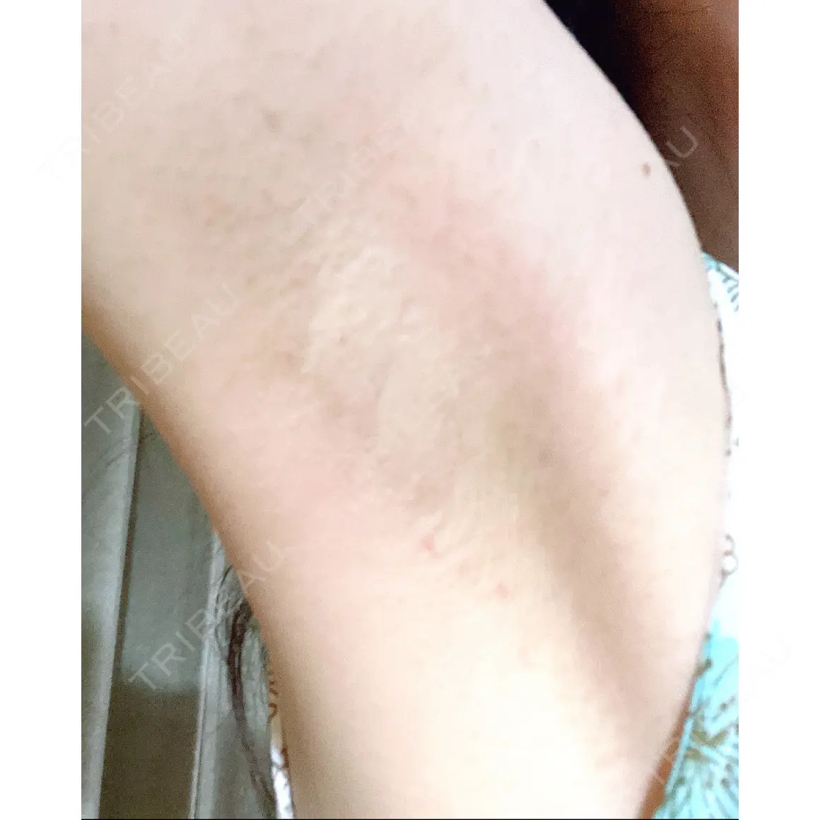 ワキ汗治療（ボトックス） Mare beauty clinic DAY 0