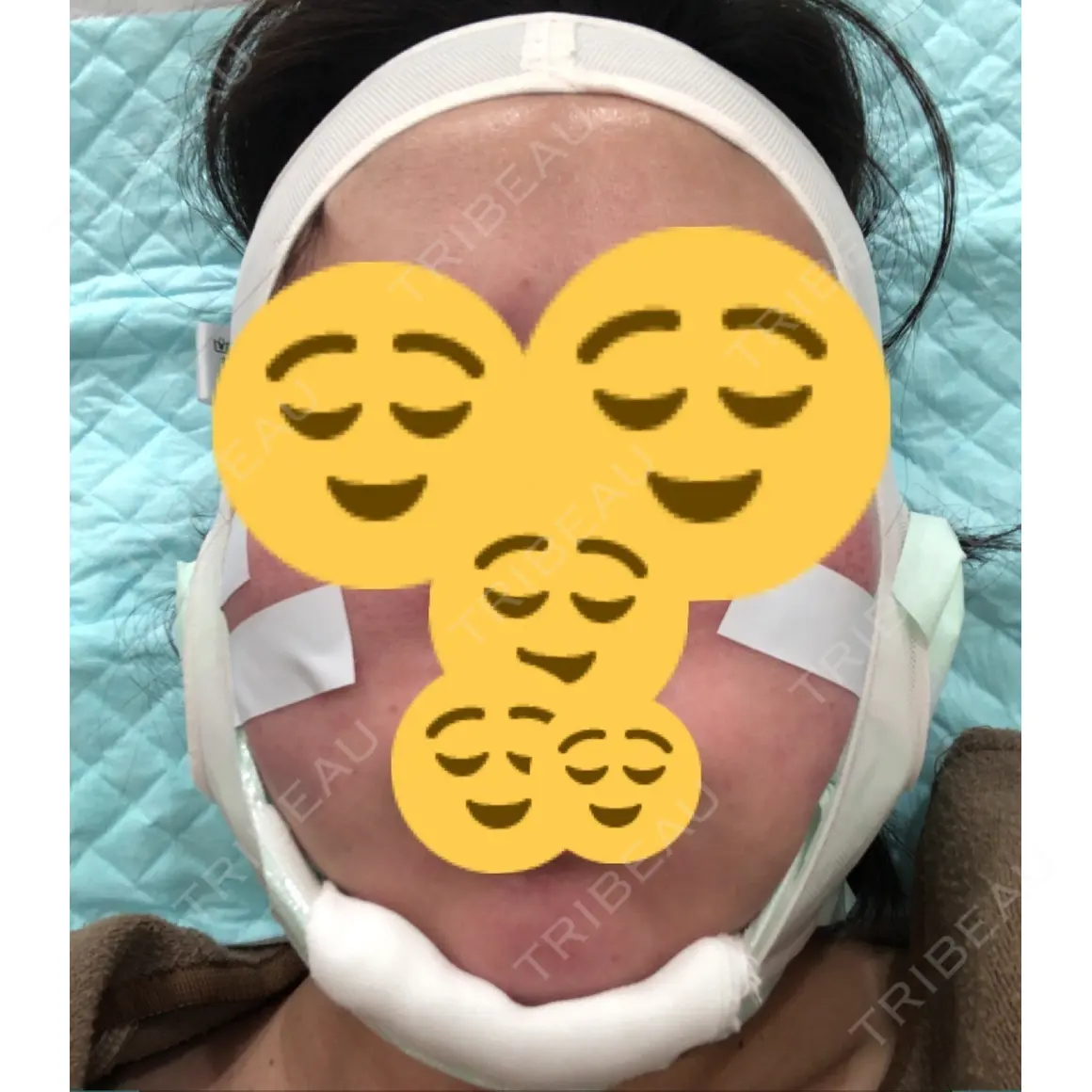 脂肪吸引（顔） Mods Clinic（モッズクリニック） 東京院 DAY 0