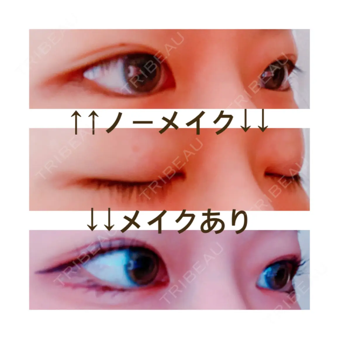 二重埋没 / 上まぶたの脂肪取り 共立美容外科 大宮院 AFTER