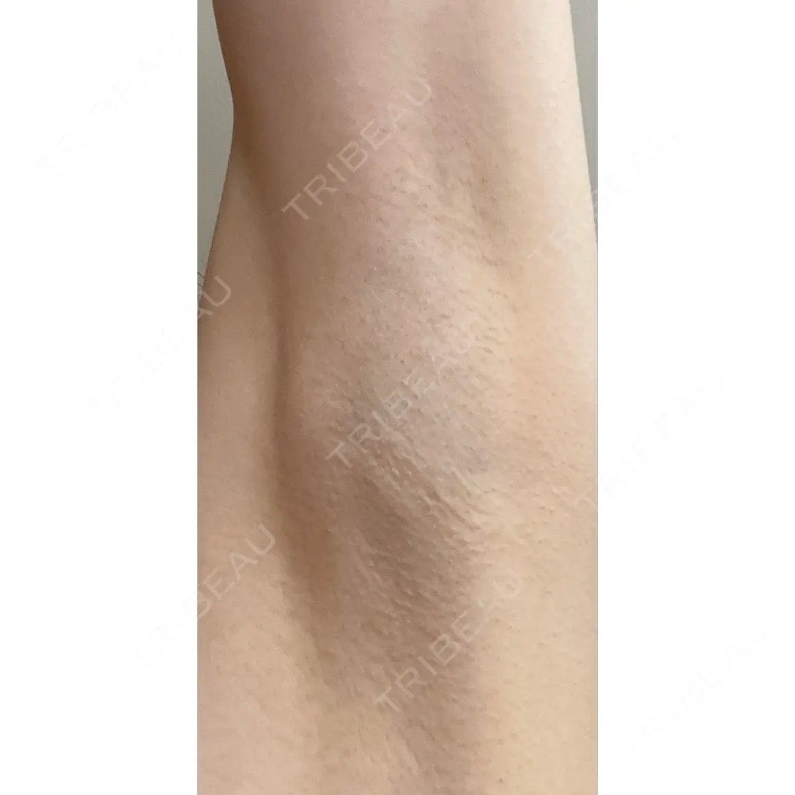 ワキ汗治療（ボトックス） Mare beauty clinic AFTER