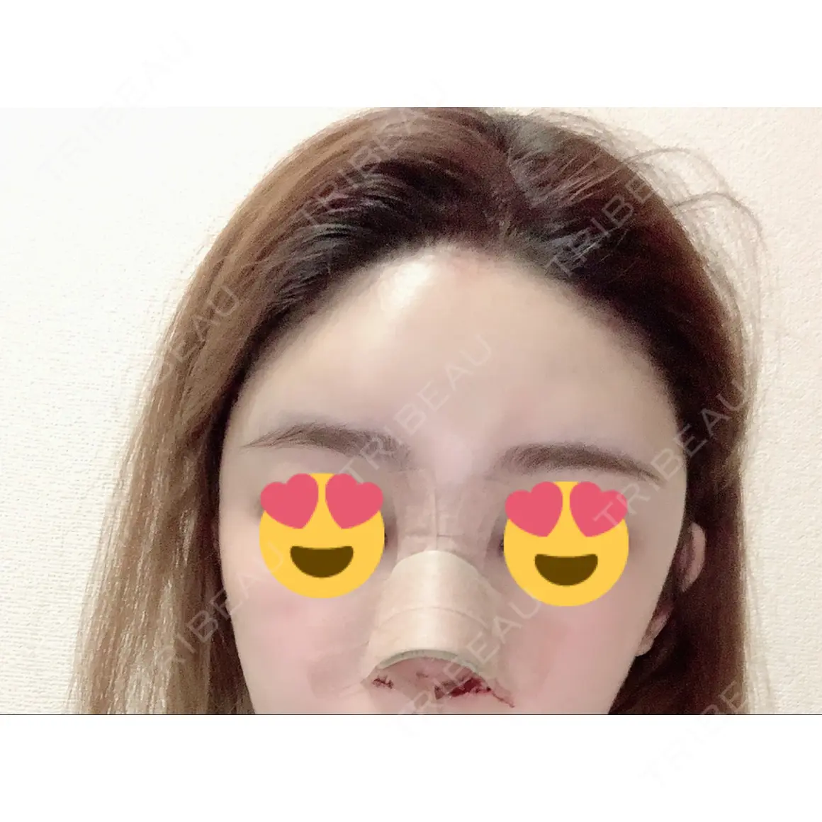 隆鼻術 / 鼻尖形成（切開） / 小鼻縮小（切開） / 額を丸く / 軟骨移植 / ヒアルロン酸注入（額） グローバルビューティークリニック 大阪院 DAY 0