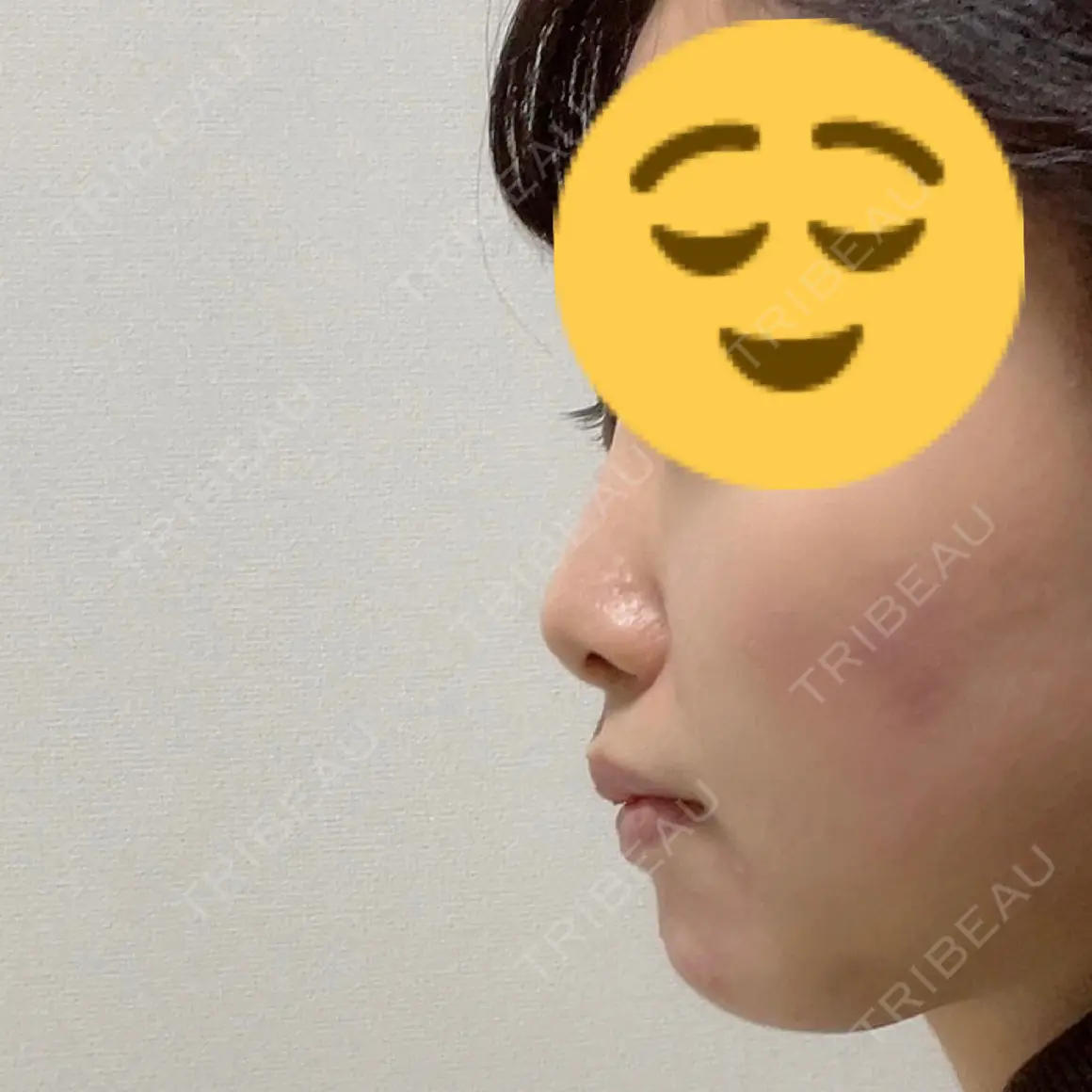 隆鼻術 / 鼻尖縮小 / ヒアルロン酸注入（鼻） 品川美容外科 福岡院 AFTER
