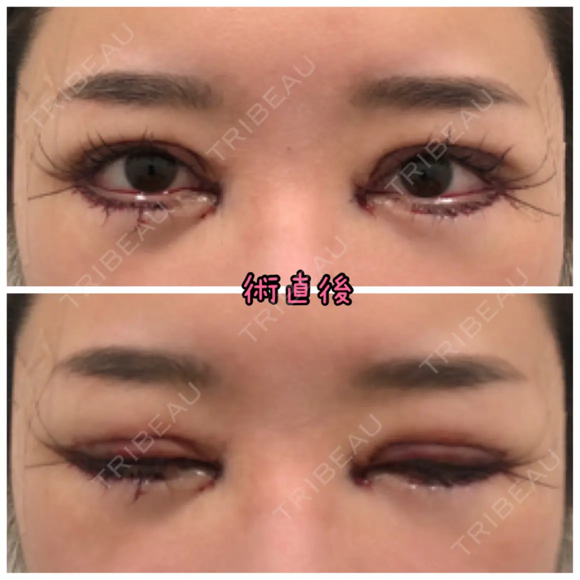 二重切開 / 目頭切開 / 眼瞼下垂（切開） / 目尻切開 / タレ目形成・グラマラスライン（切開） eクリニック 金沢本院 DAY 0