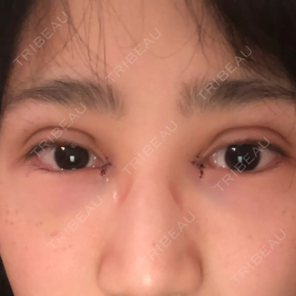 二重埋没 / 目頭切開 / 上まぶたの脂肪取り 湘南美容クリニック 柏院 DAY 0