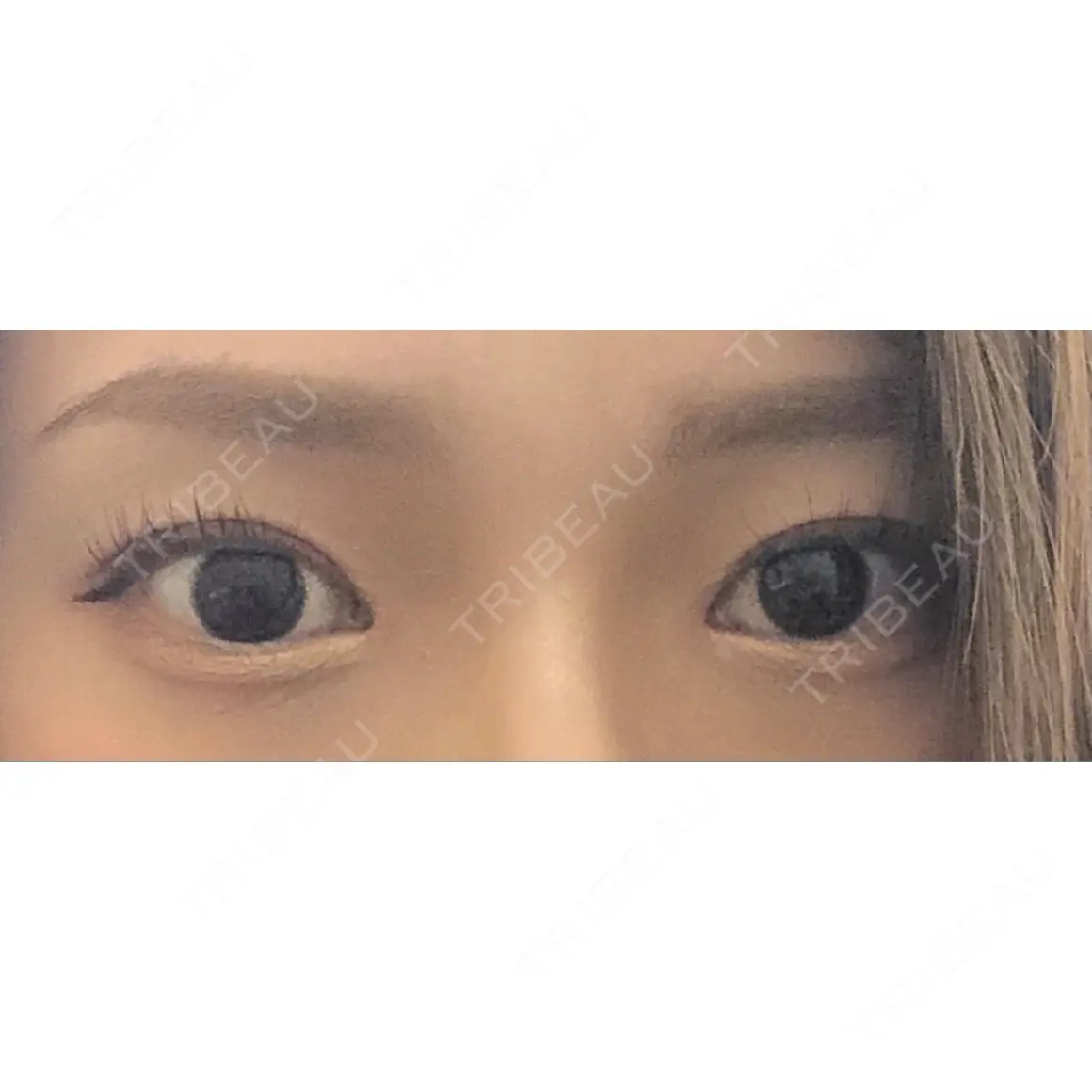 目頭切開 聖心美容クリニック 札幌院 AFTER