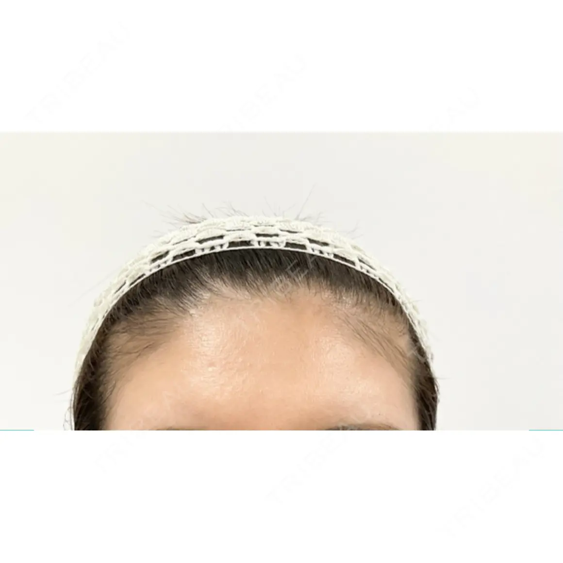 ボトックス（額） / 再生医療 クリニックビューティー恵比寿 AFTER