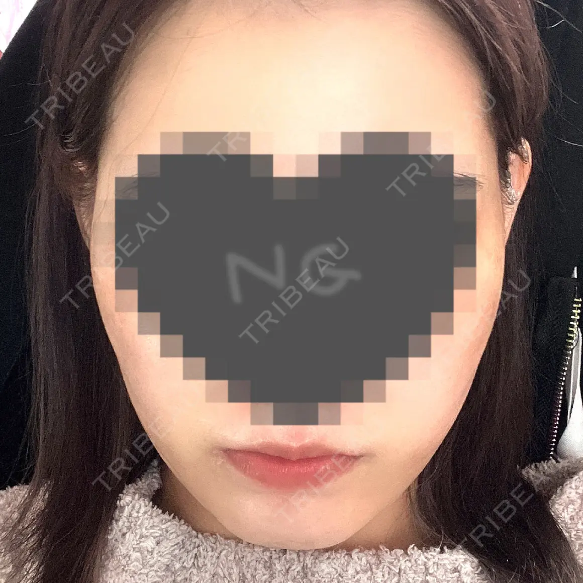 脂肪溶解注射（顔） 東京ロイヤルクリニック AFTER
