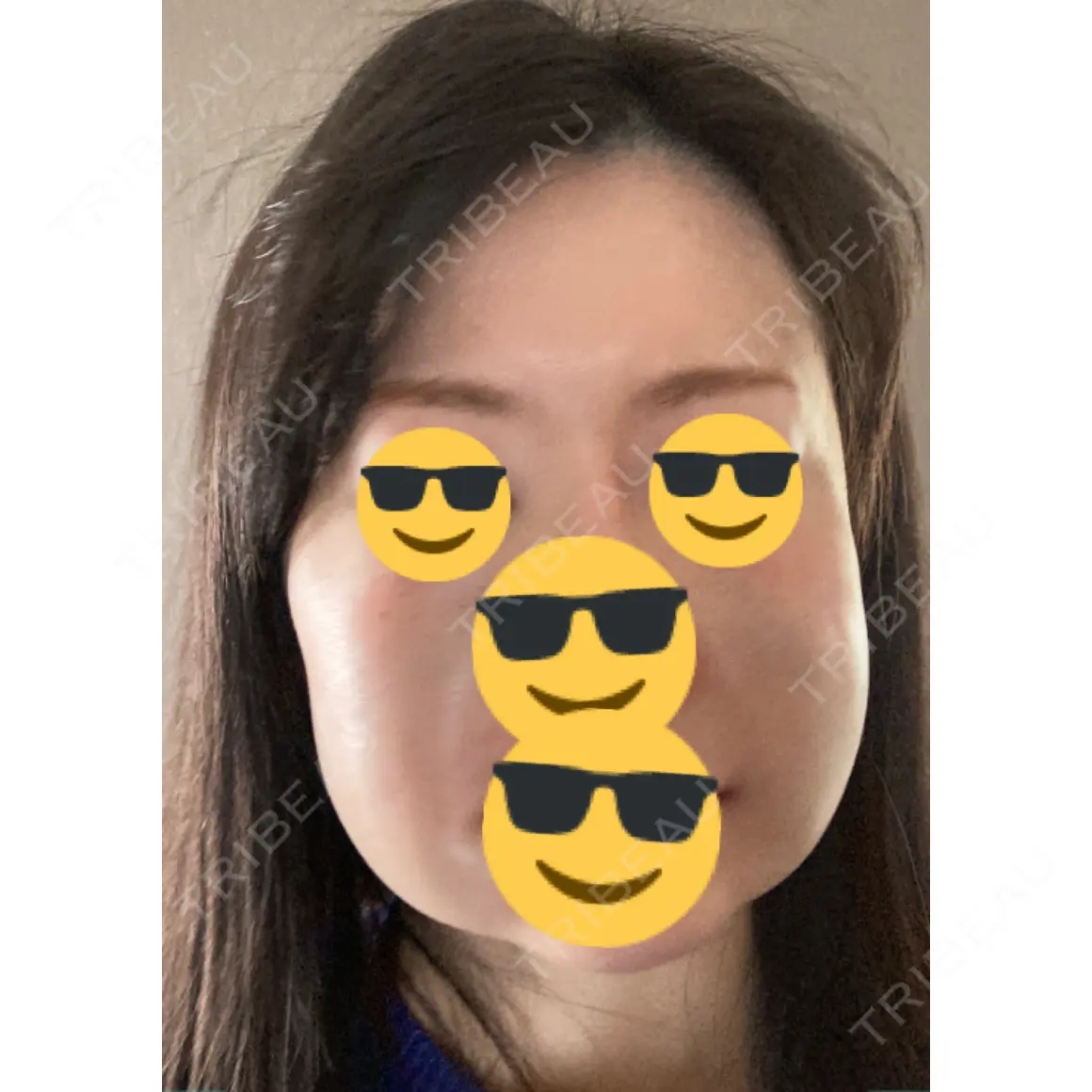 水光注射（ハリ・美肌） / 脂肪溶解注射（顔） / PRP皮膚再生療法 プルージュ美容クリニック 赤羽院 DAY 0