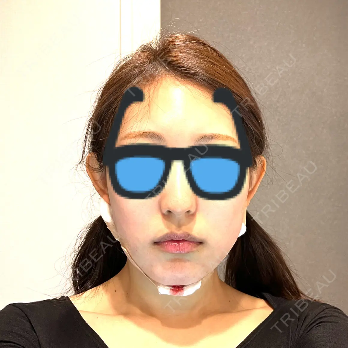 脂肪吸引（顔） くさのたろうクリニック DAY 0