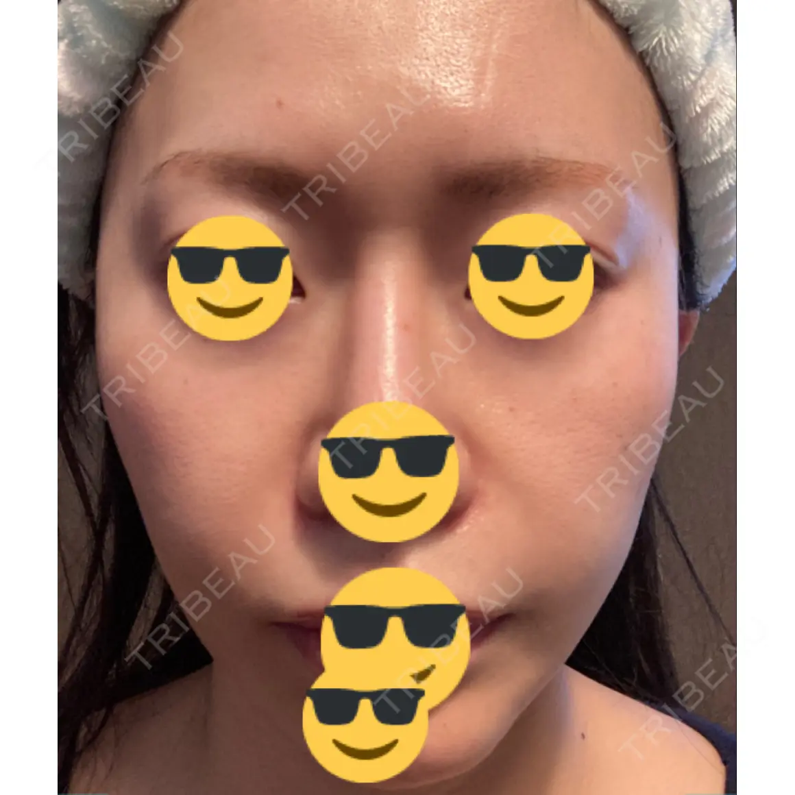 水光注射（ハリ・美肌） / 脂肪溶解注射（顔） / PRP皮膚再生療法 プルージュ美容クリニック 赤羽院 AFTER