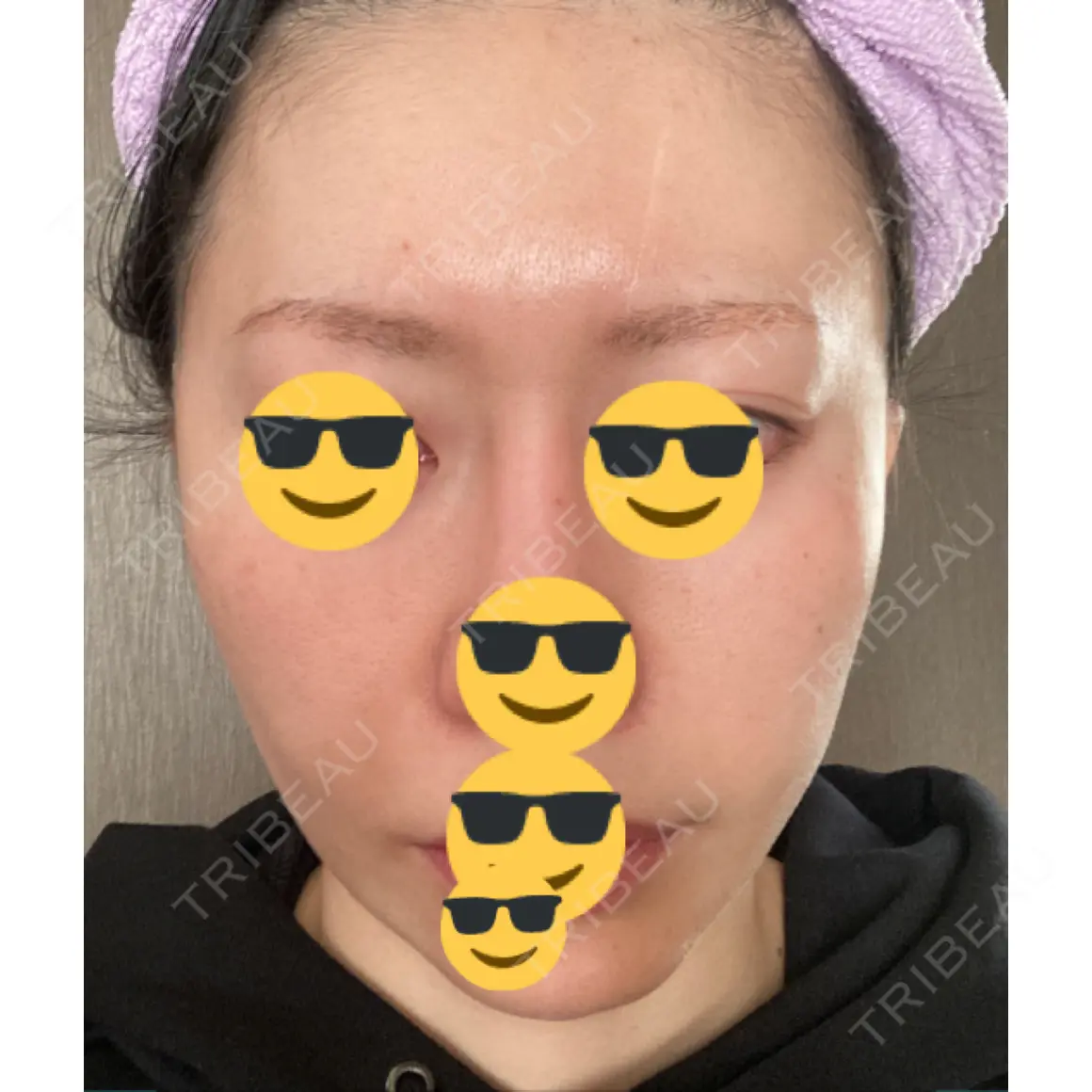 水光注射（ハリ・美肌） / 脂肪溶解注射（顔） / PRP皮膚再生療法 プルージュ美容クリニック 赤羽院 AFTER