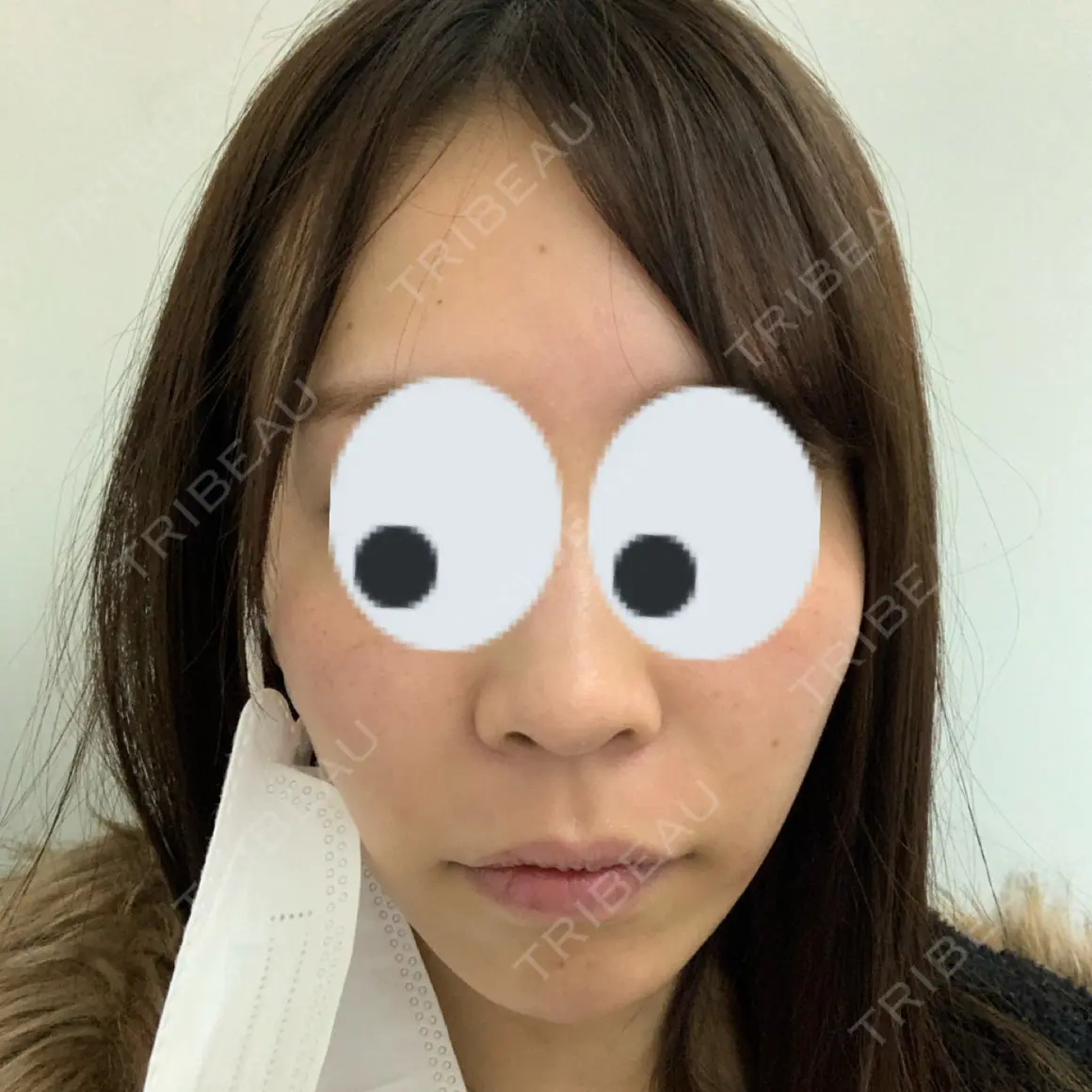 ガミースマイル手術 オーラルビューティークリニック白金 DAY 0