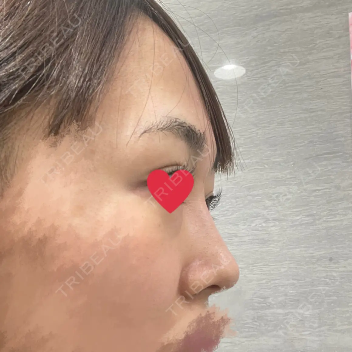 ヒアルロン酸注入（鼻） アクトリー勝どきウェルネスメディカルクリニック DAY 0