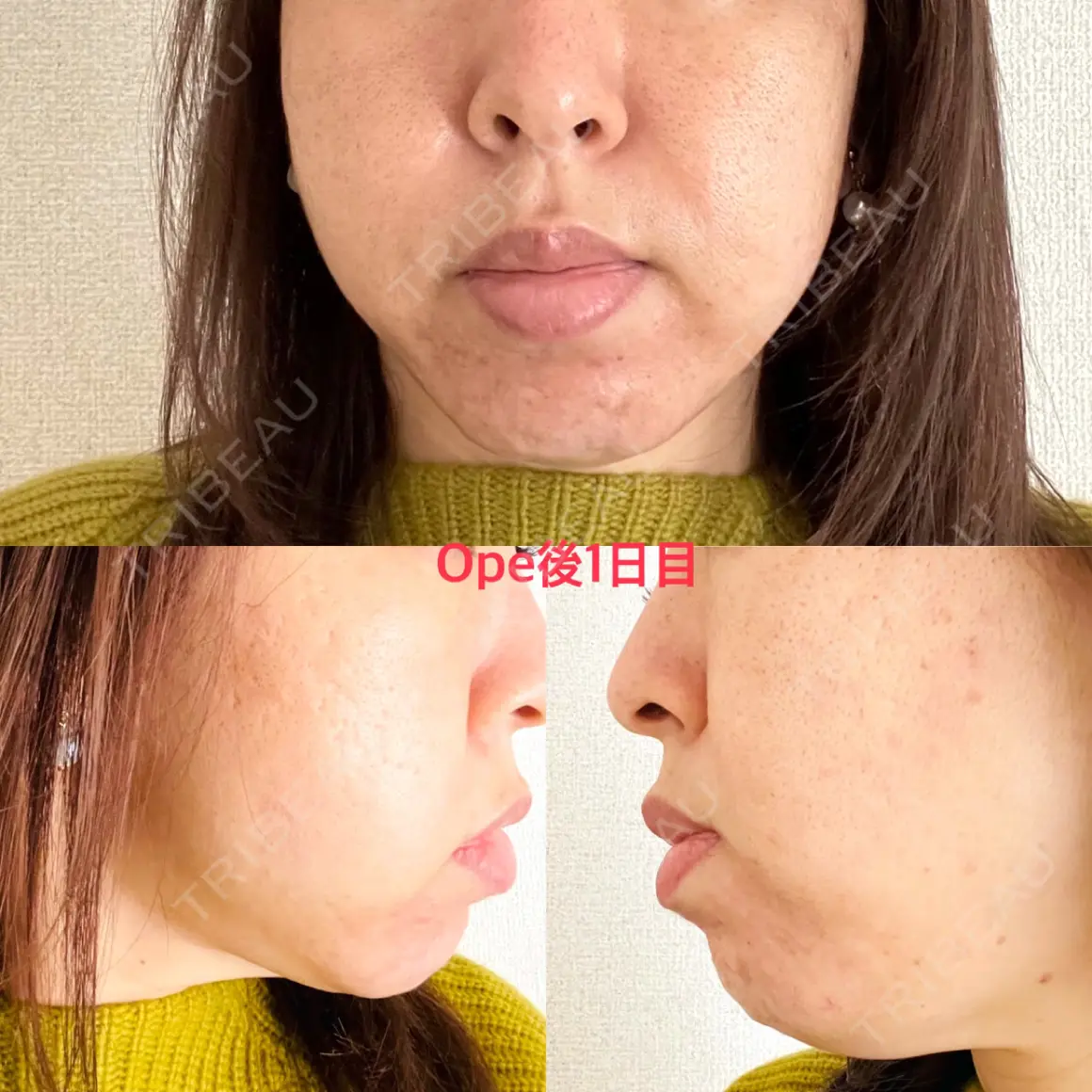 糸リフト / 脂肪溶解注射（顔） / ヒアルロン酸注入（頬） X CLINIC 銀座院 DAY 1