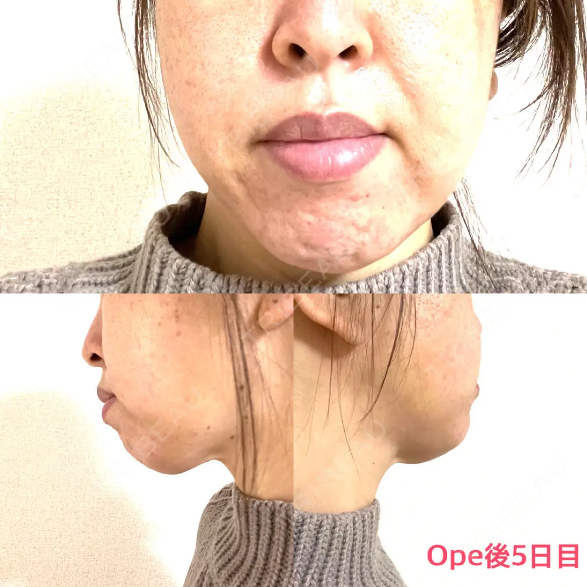 糸リフト / 脂肪溶解注射（顔） / ヒアルロン酸注入（頬） X CLINIC 銀座院 AFTER