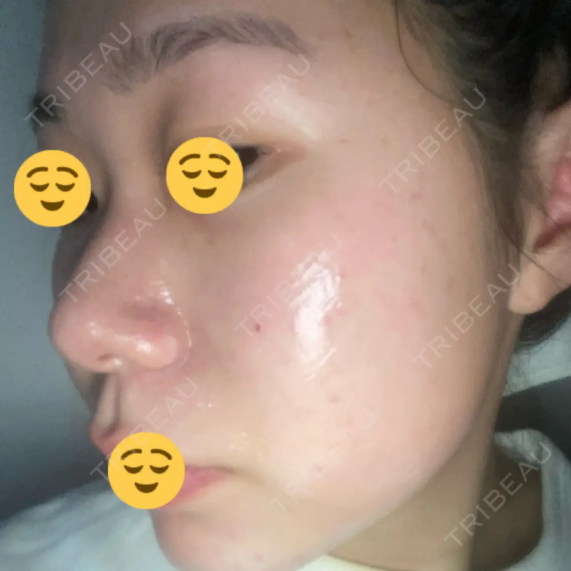 イオン導入 / ピーリング（ハリ・ツヤ） 渋谷美容外科クリニック 横浜院 AFTER