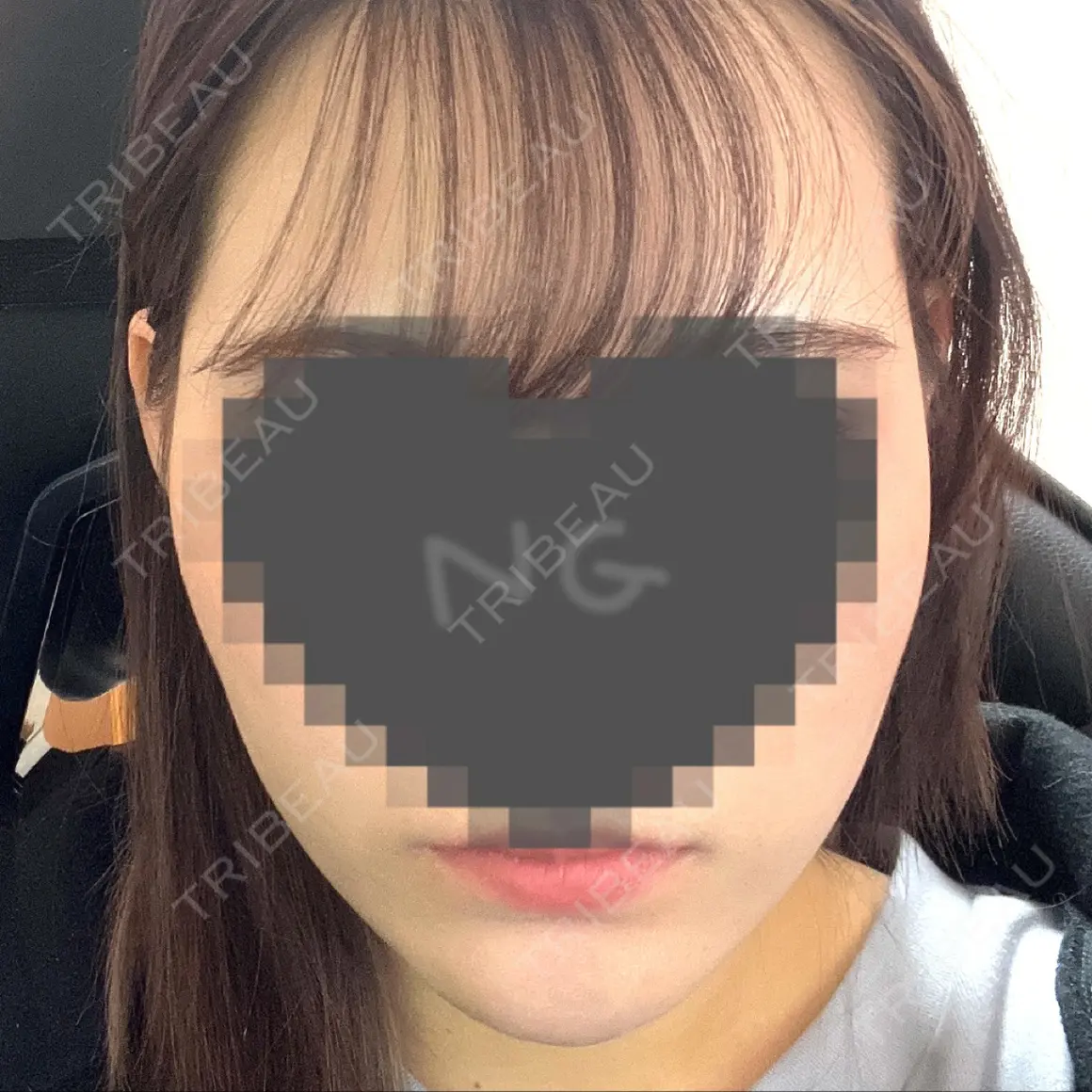 脂肪溶解注射（顔） 東京ロイヤルクリニック AFTER