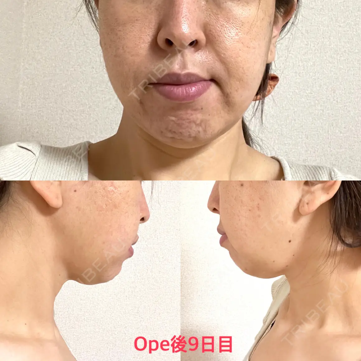 糸リフト / 脂肪溶解注射（顔） / ヒアルロン酸注入（頬） X CLINIC 銀座院 AFTER