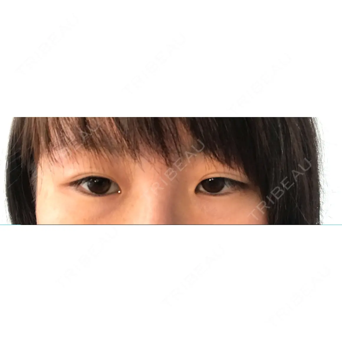 二重切開 高須クリニック 名古屋院 AFTER