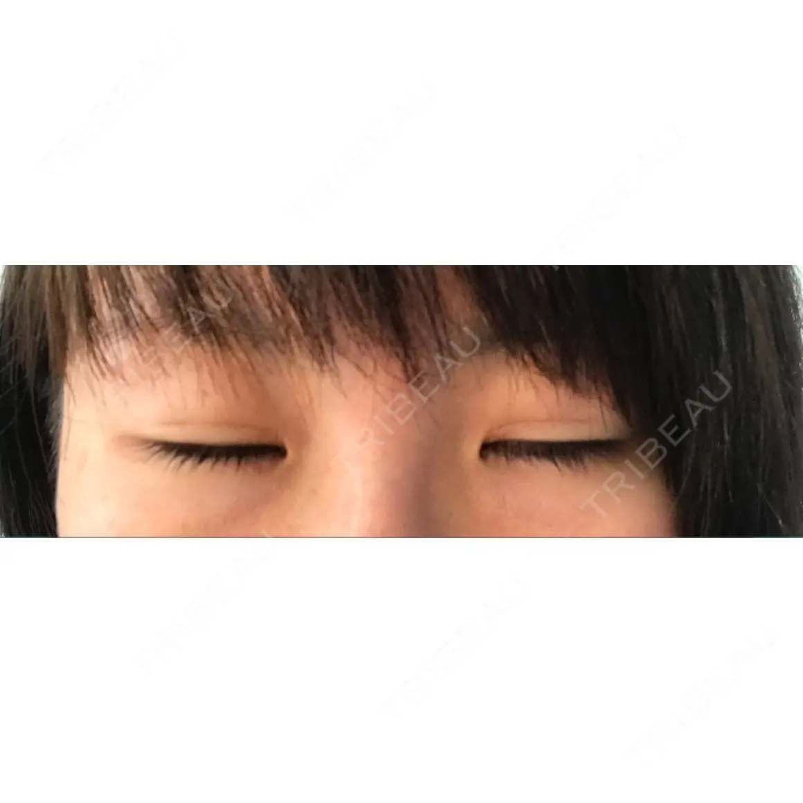 二重切開 高須クリニック 名古屋院 AFTER