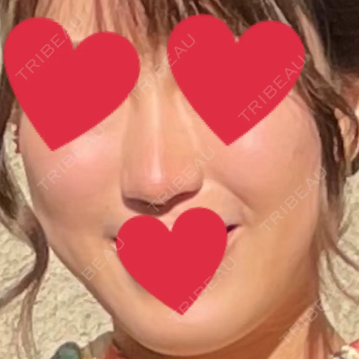 隆鼻術 / 鼻尖形成（切開） / 小鼻縮小（切開） / 軟骨移植 グローバルビューティークリニック 大阪院 AFTER